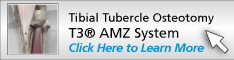 Tibial Tubercle Osteotomy using the T3® AMZ<br>
						System